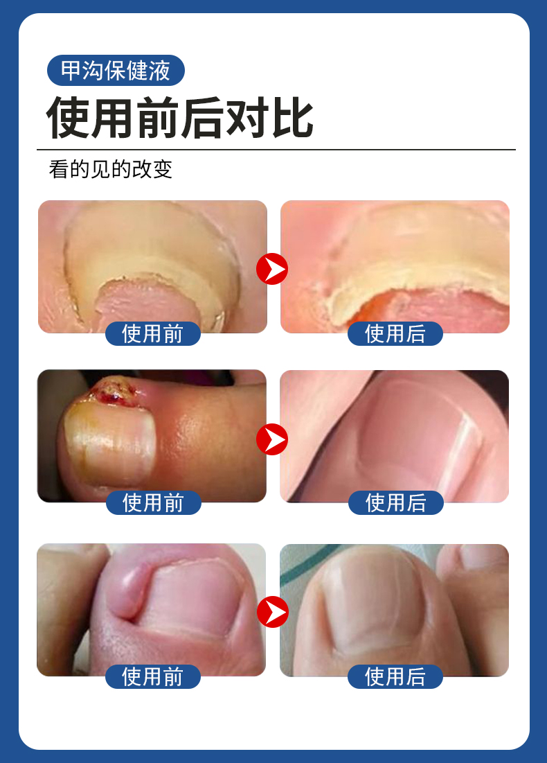 甲溝炎專(zhuān)用液有用嗎？使用前后對(duì)比