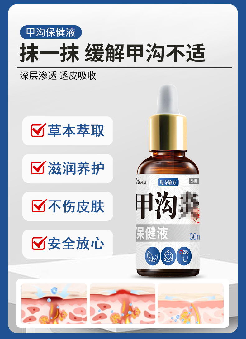 抹一抹，緩解甲溝不適